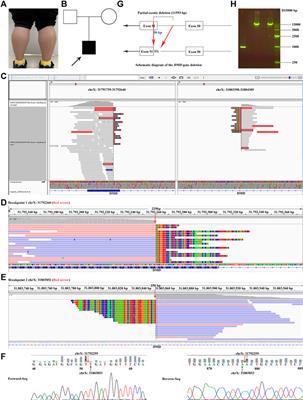 Novel Partial Exon 51 Deletion in the Duchenne Muscular Dystrophy Gene Identified via Whole Exome Sequencing and Long-Read Whole-Genome Sequencing